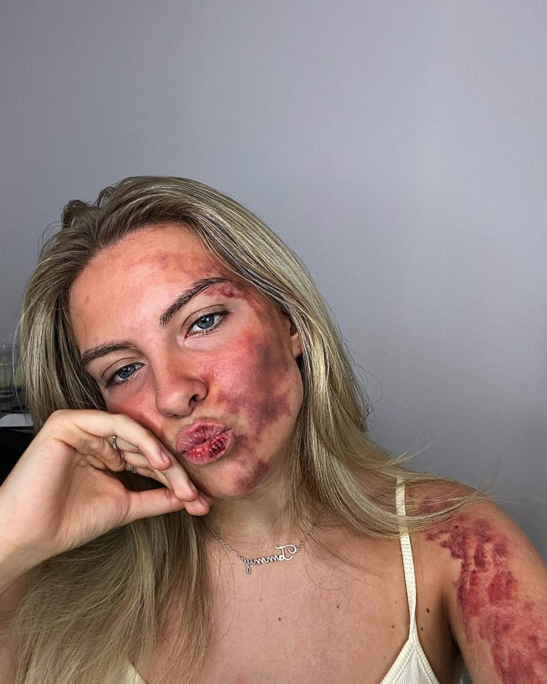 Basit bir uçuk zannetti, korkunç hastalığa yakalandı! Doktorlar bile teşhis koyamadı 4